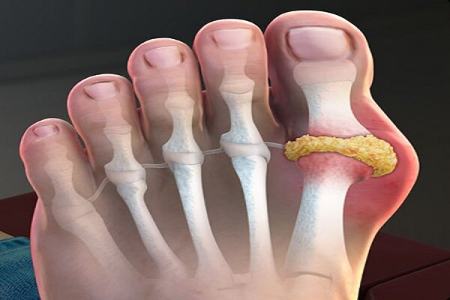 نقرس،اخبار پزشکی،خبرهای پزشکی نقرس،اخبار پزشکی،خبرهای پزشکی