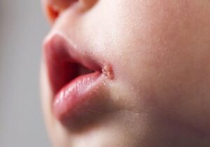 تفاوت آفت و تبخال در کودکان